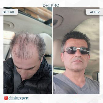 DHI Pro – Hair Transplant – Before and After results