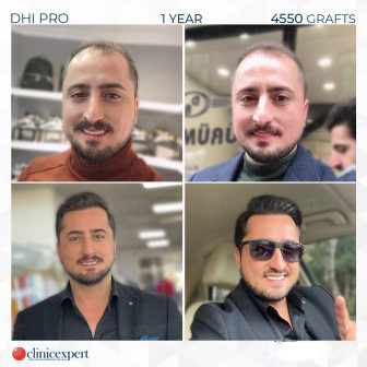 DHI Pro – Hair Transplant – One Year- 4750 Grafts