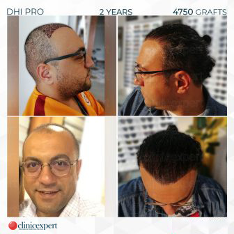 DHI Pro – Hair Transplant – 2 Years- 4750 Grafts
