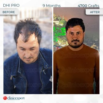 DHI Pro – Hair Transplant – 9 months - 4700 Grafts
