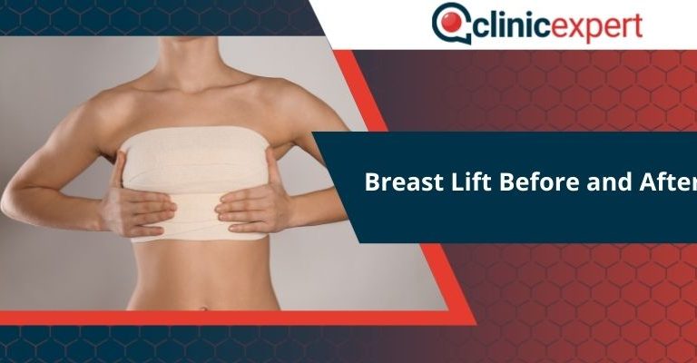 Breast Lift Before and After