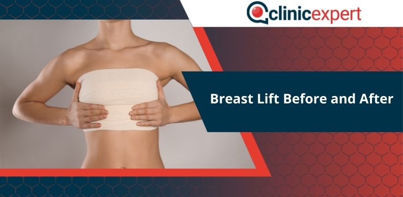 Breast Lift Before and After