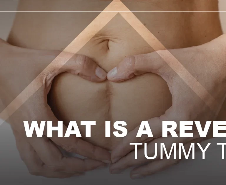 reverse-tummy-tuck