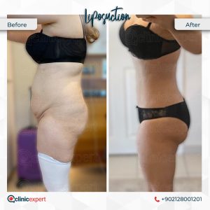 Liposuction-Turkey