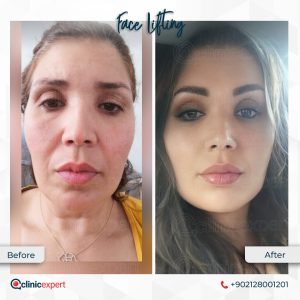 Facelift Cost in Turkey