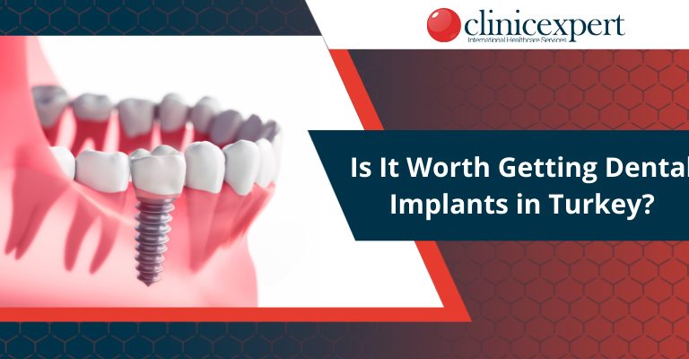 Is It Worth Getting Dental Implants in Turkey?