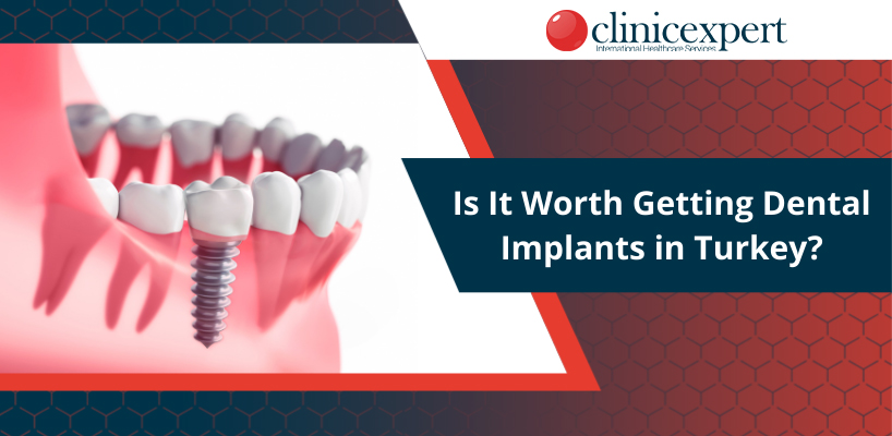 Is It Worth Getting Dental Implants in Turkey?