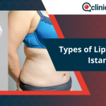 Types of Liposuction in Istanbul