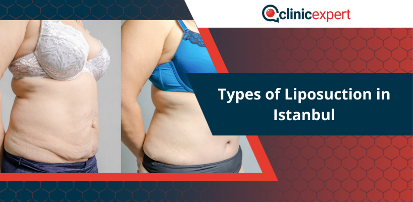Types of Liposuction in Istanbul