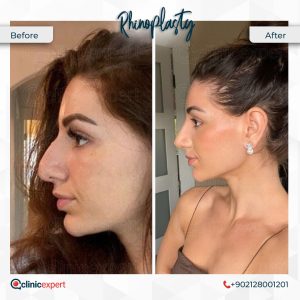 Does Rhinoplasty Change Your Face?