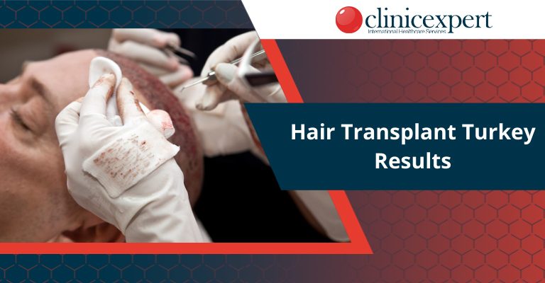 Hair Transplant Turkey Results