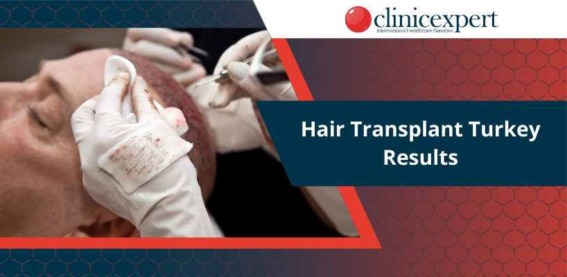 Hair Transplant Turkey Results