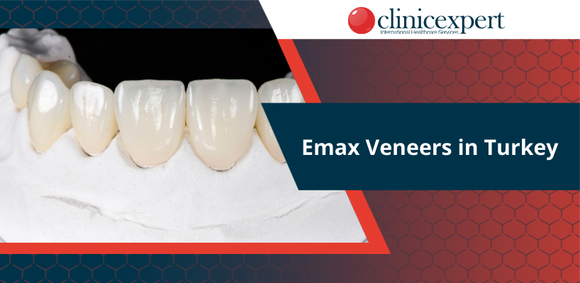 E-Max Veneers in Turkey