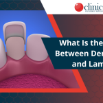 What Is the Difference Between Dental Veneers and Laminates?