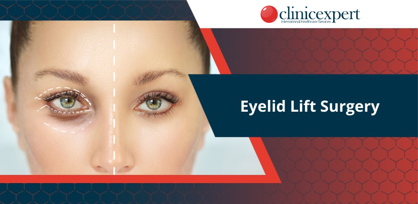 Eyelid Lift Surgery