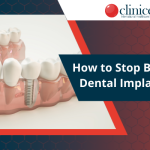 How to Stop Bleeding After Dental Implant Surgery?