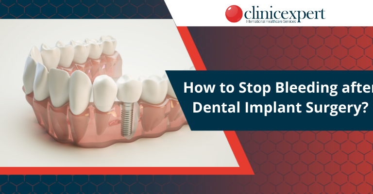 How to Stop Bleeding After Dental Implant Surgery?