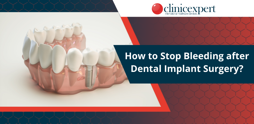 How to Stop Bleeding After Dental Implant Surgery?