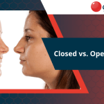 closed-vs-open-rhinoplasty