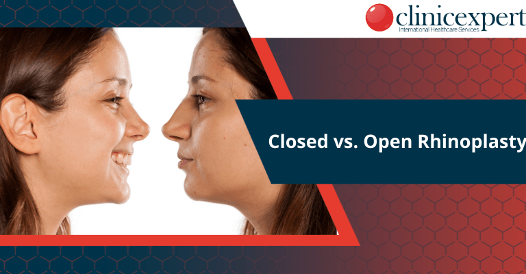 closed-vs-open-rhinoplasty