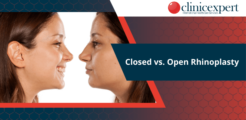 closed-vs-open-rhinoplasty