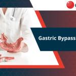 gastric-bypass-vs-lap-band
