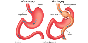 gastric-bypass-vs-lap-band-3