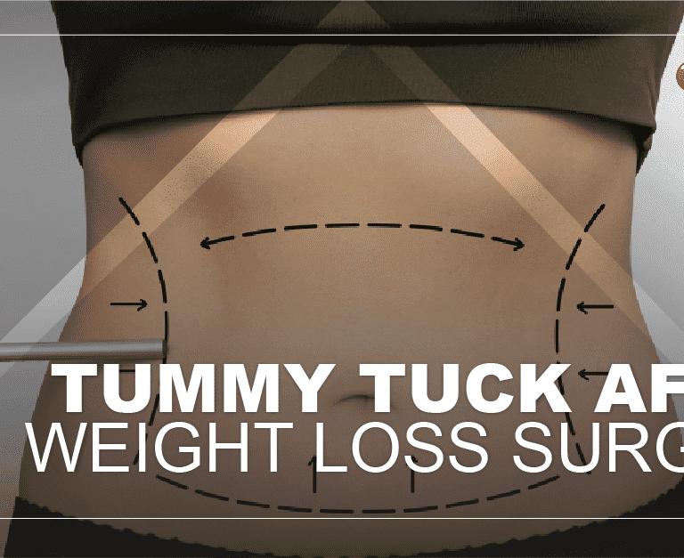 TUMMY-TUCK-min