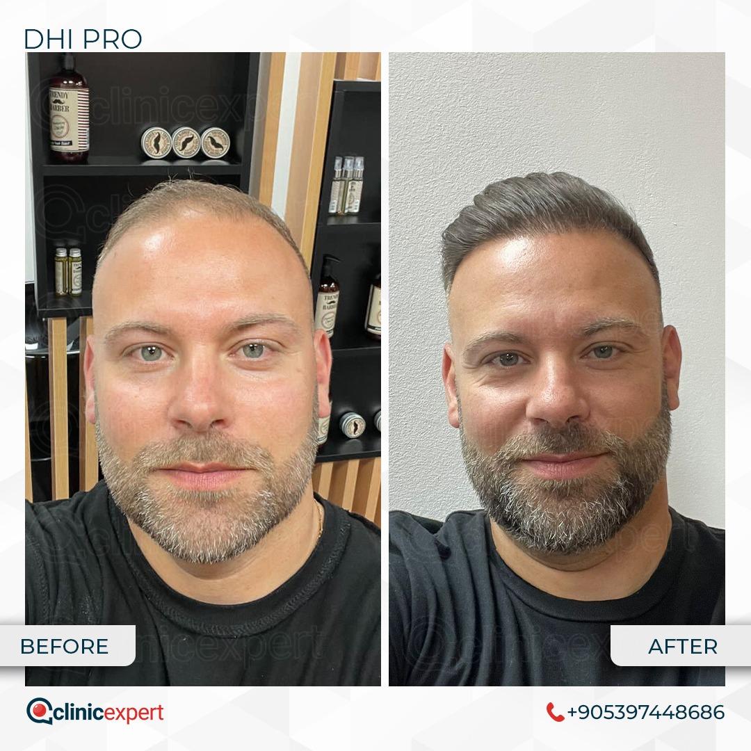 Hair Transplant Clinics  DHI International  Scalp MicroPigmentation  MPG 5 hours nonsurgical procedure DHIHairTransplant dhimedicalgroup  Call 1800 103 9300 or Book Consultation Online httpsgooglX9oAJT  HairLoss HairRestoration 