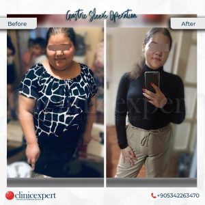 3 Months After Gastric Sleeve