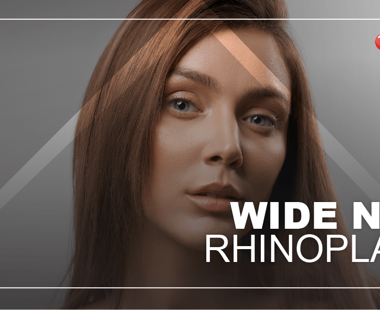 wide-nose-rhinoplasty