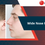wide-nose-rhinoplasty