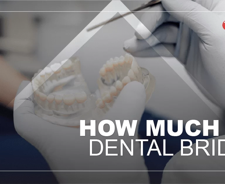 cost-of-dental-bridge