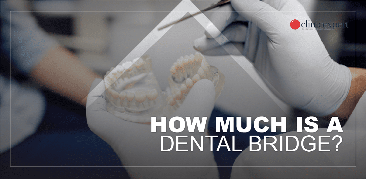 cost-of-dental-bridge