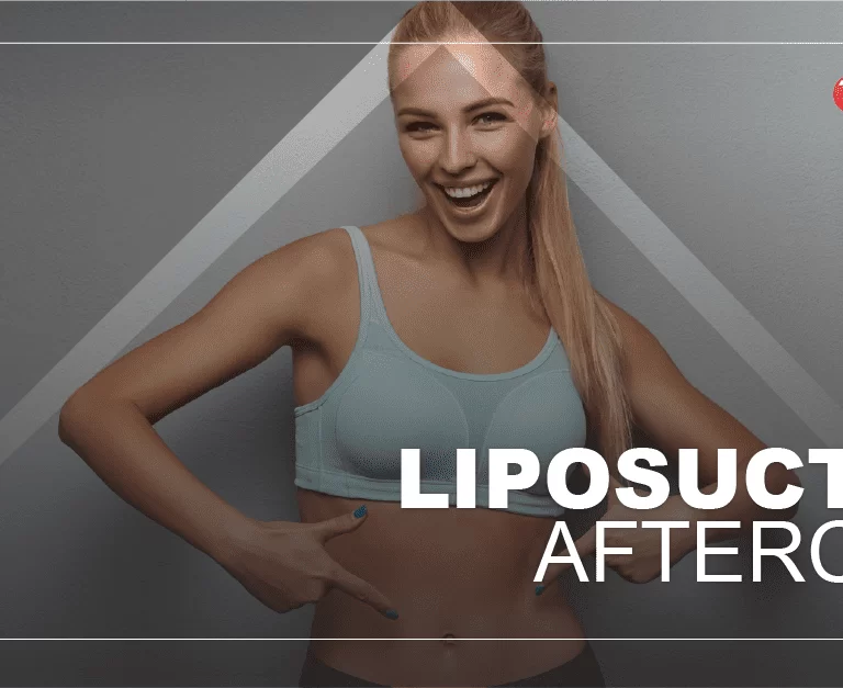 liposuction-aftercare
