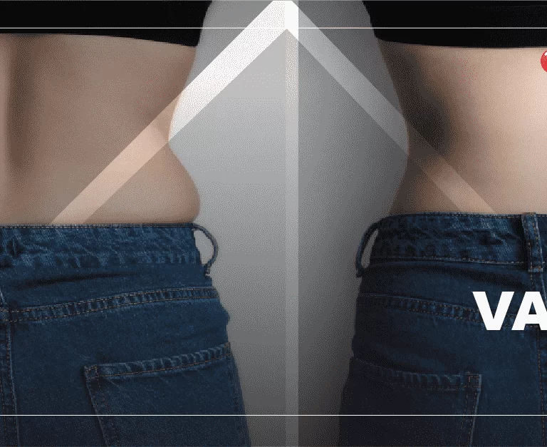 vaser-lipo-before-and-after