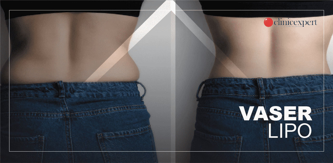vaser-lipo-before-and-after