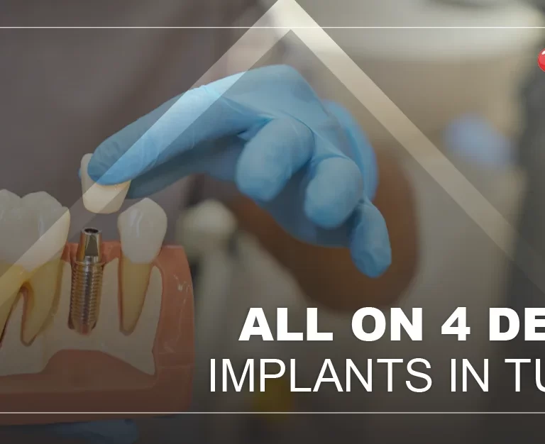 All-on-4-dental-implant-Turkey