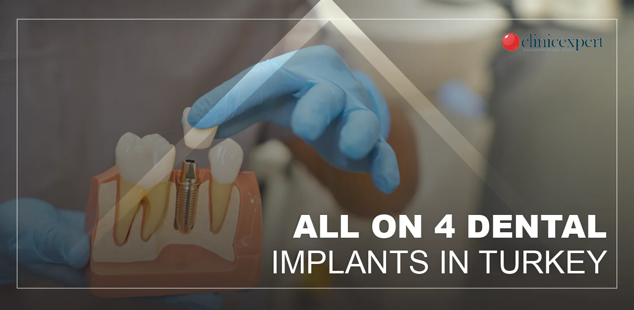 All-on-4-dental-implant-Turkey