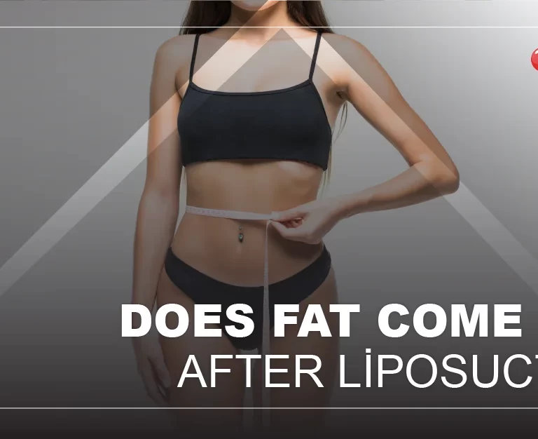 Does Fat Come Back after Liposuction