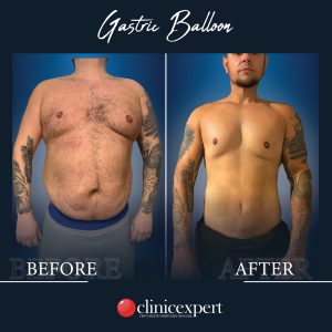 gastric-balloon-before-after