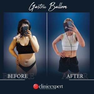 Gastric Balloon-before-after-2