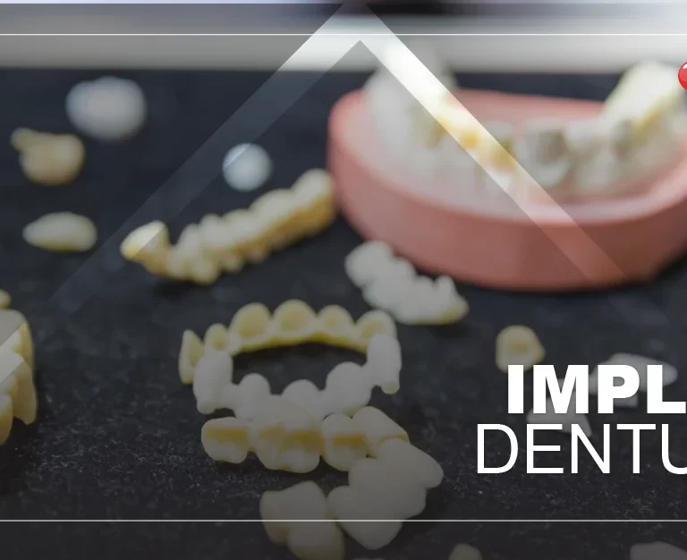 implant-retained-dentures