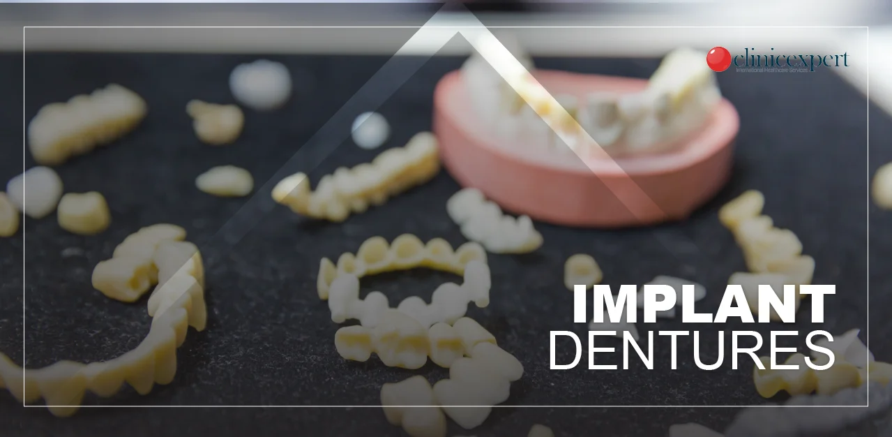 implant-retained-dentures