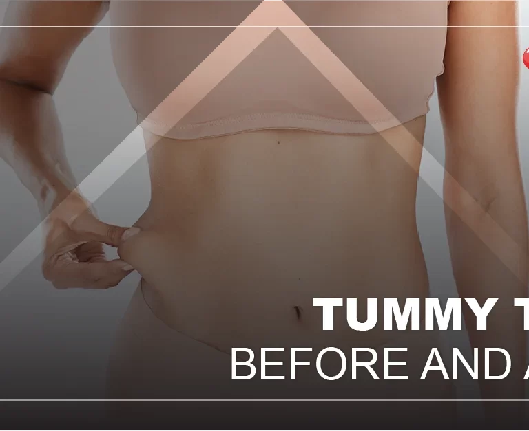 tummy-tuck-before-after