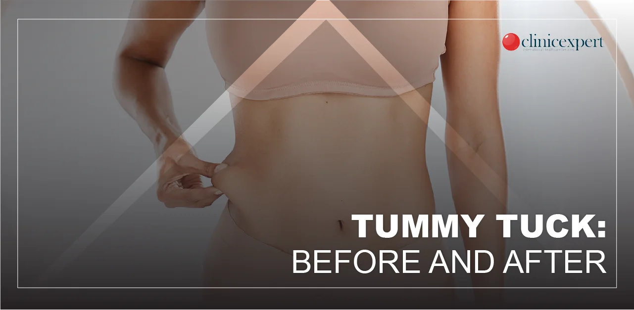 Before and After a Tummy Tuck