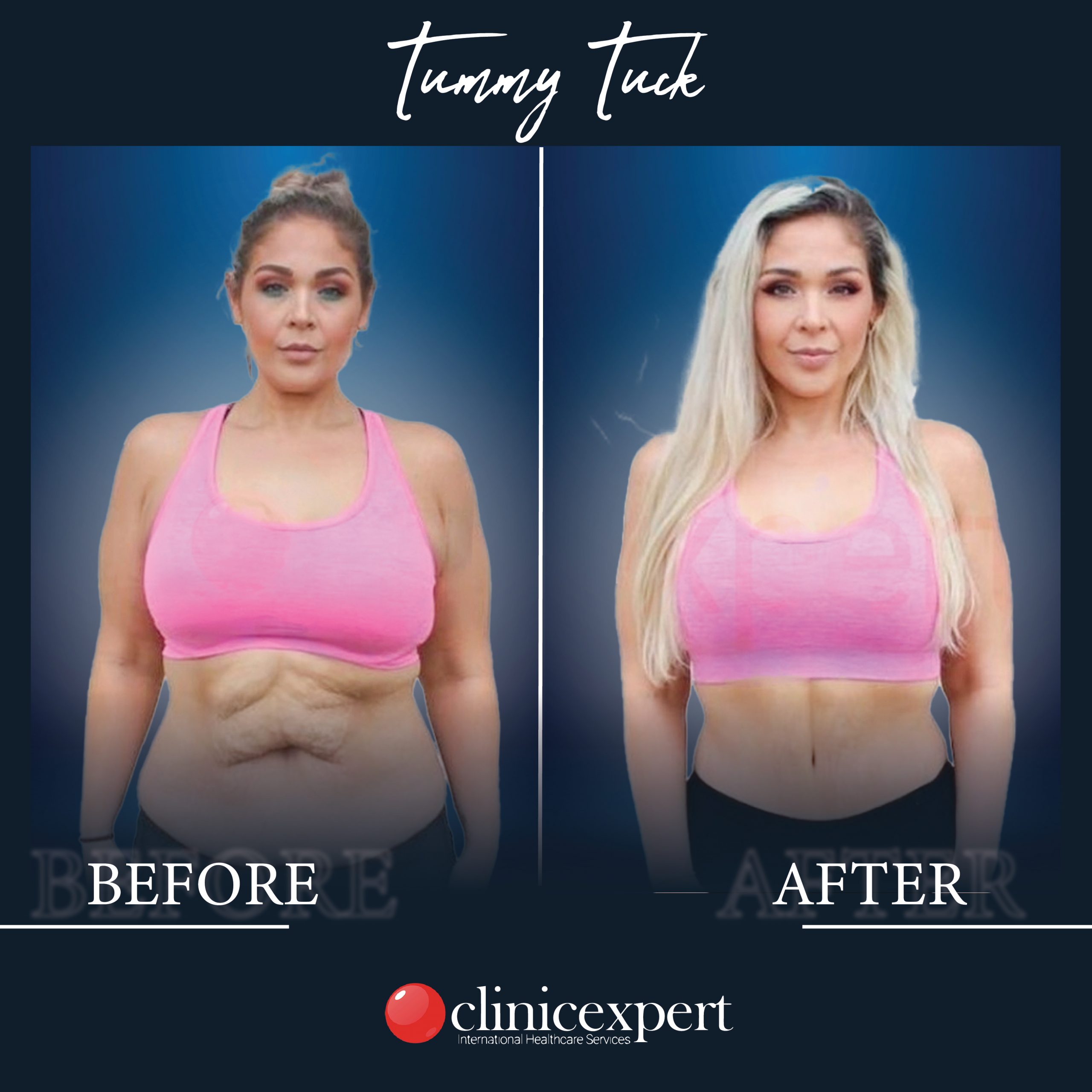 Before and After a Tummy Tuck