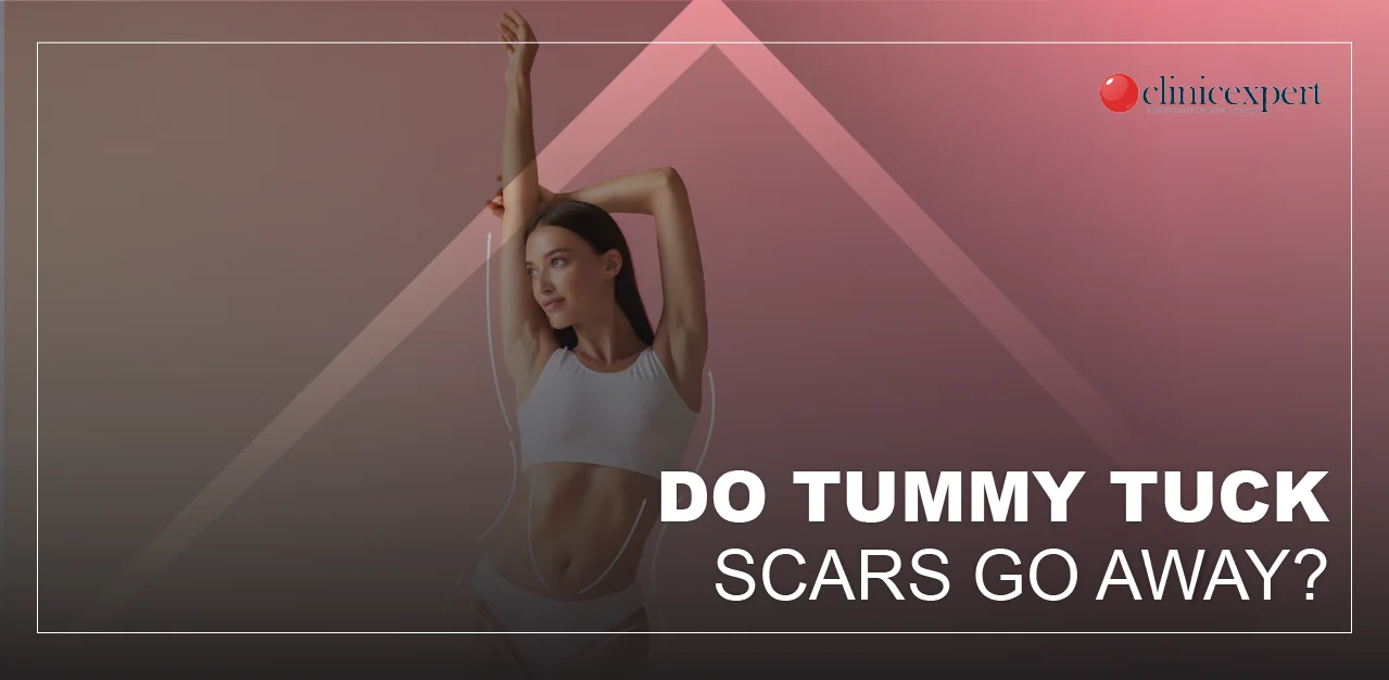 DO TUMMY TUCK SCARS GO AWAY