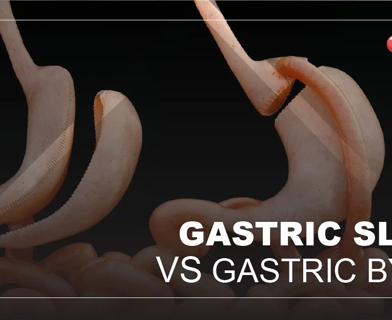 GASTRIC SLEEVE VS GASTRIC BYPASS