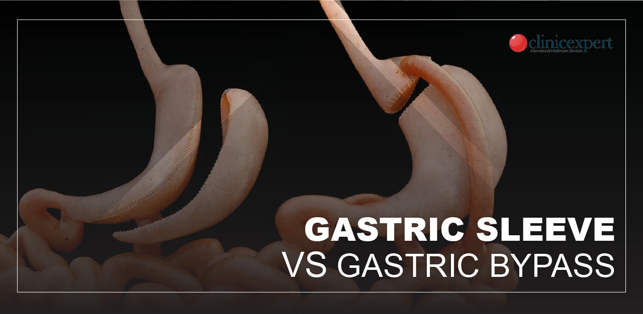 GASTRIC SLEEVE VS GASTRIC BYPASS